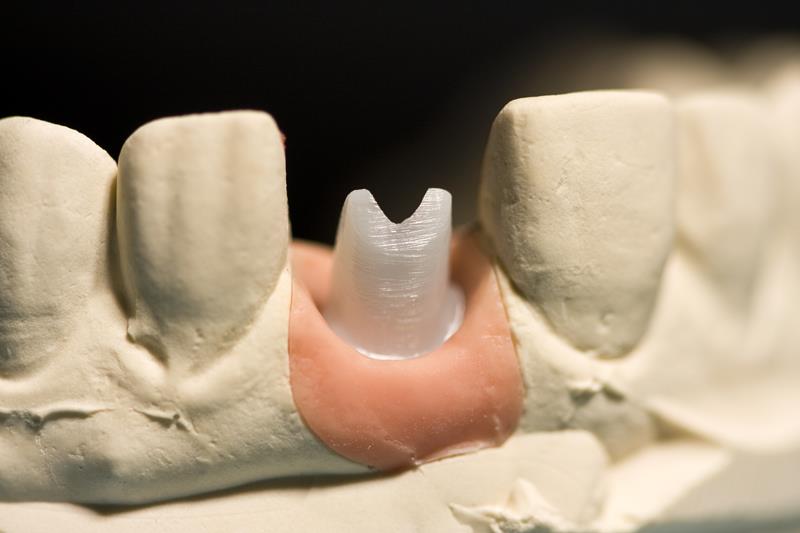 Philadelphia Implant Restoration