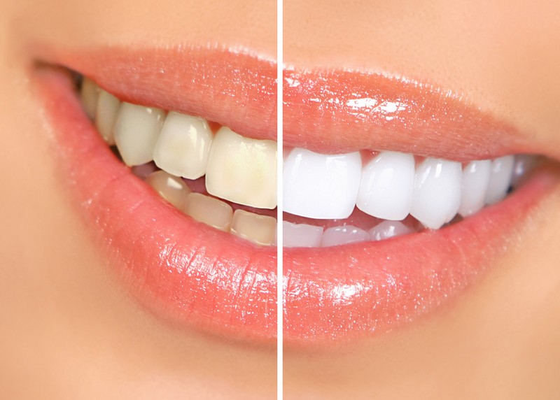 Philadelphia Teeth Whitening