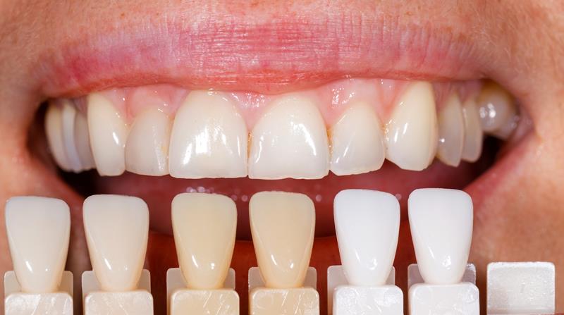 Philadelphia Veneers