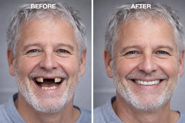 Permanent Full-Arch Dental Implants in Southampton 6 After