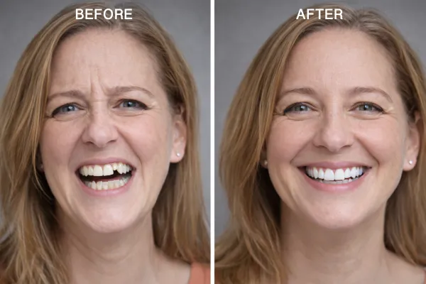 Permanent Full-Arch Dental Implants in Southampton 7 Jennifer Before-After