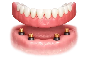 Snap on Denture 1